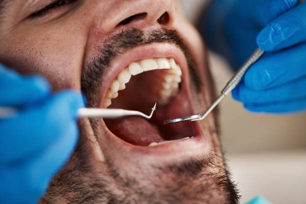Best Urgent Care for Lost Fillings or Crowns in Kennesaw, GA